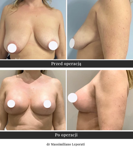 Breast lift with implants