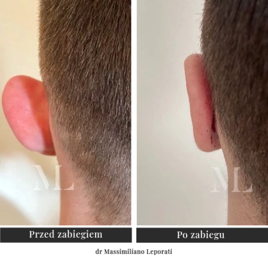 Corrective plastic surgery of prominent ears