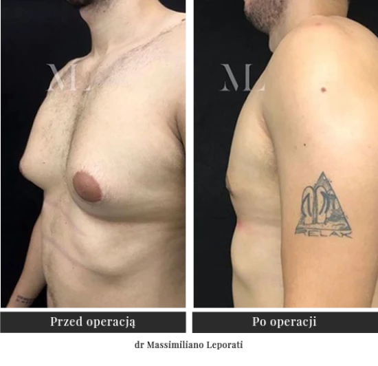 Gynecomastia surgery