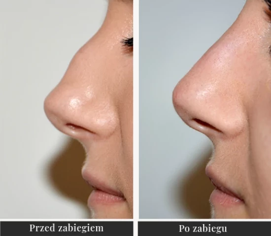Nose modelling with hyaluronic acid