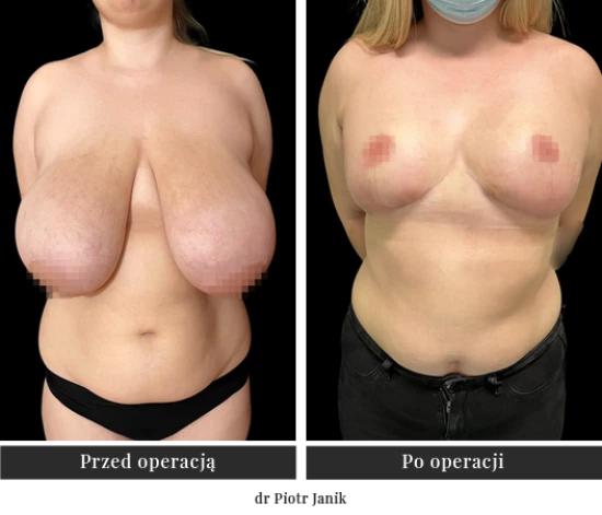 Breast reduction